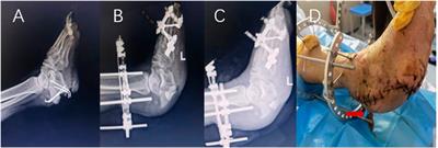 Analysis of risk factors for serous exudation of biodegradable material calcium sulfate in the treatment of fracture-related infections